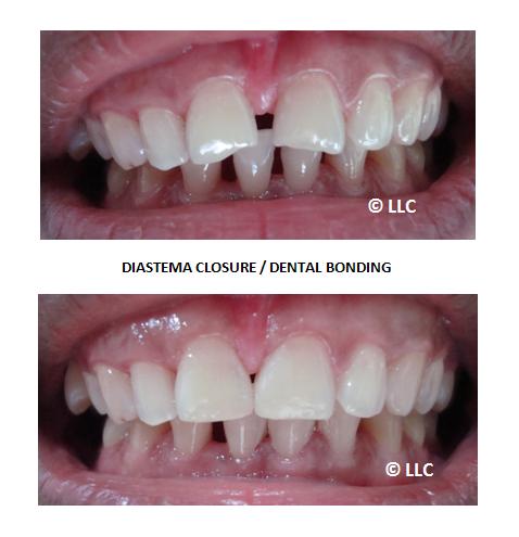 Dental Bonding Resin 